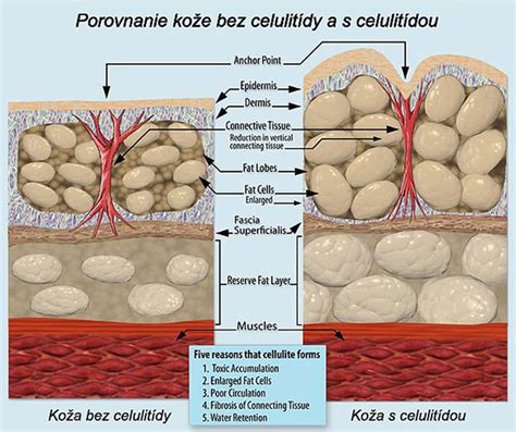 Štruktúra pokožky s celulitídou