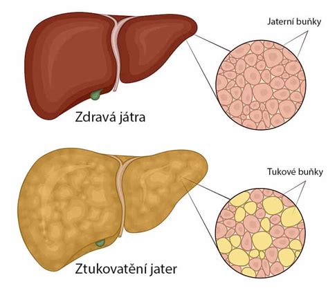 Stukovatená pečeň