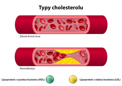 Ilustrácia cholesterolu v cievach