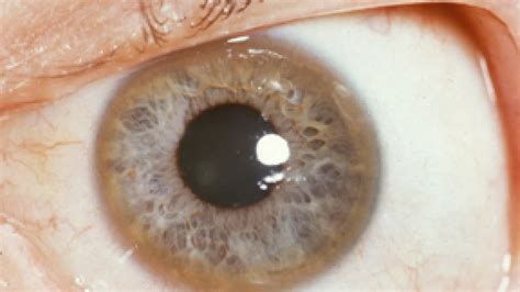 Kayser-Fleischerov prstenec na oku