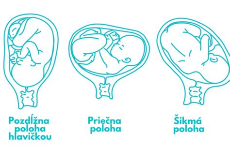 Schéma umiestnenia cervikálneho pesaru v maternici