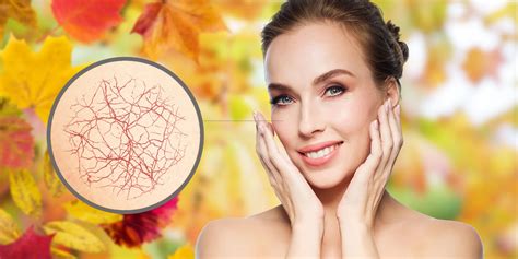 Príklady popraskaných cievok na tvári