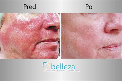 Schéma fungovania laserovej liečby cievok