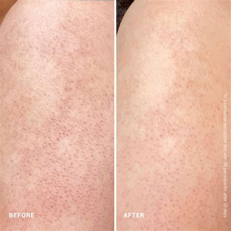 Kožná textúra pri keratóze pilaris