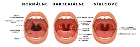 Ilustrácia ľudského nosohltana a hrdla s vyznačeným zatekaním hlienu