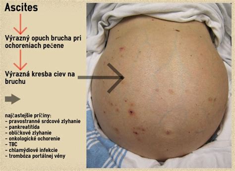 Opuch brucha pri zlyhávaní pečene (ascites)