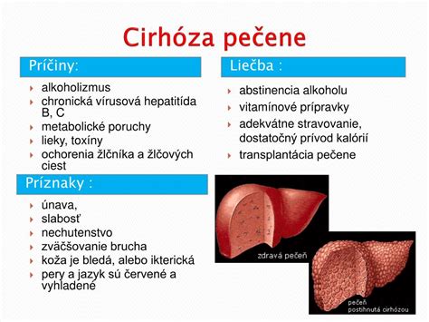 Schematické znázornenie zjazveného tkaniva pečene pri cirhóze