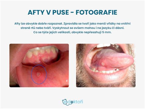 Široké spektrum liekov na afty a zápaly v ústach