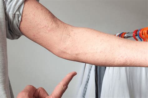 Alergická reakcia na tekvicové semienka