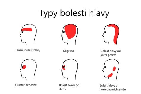 Schéma rôznych typov bolesti hlavy s lokalizáciou