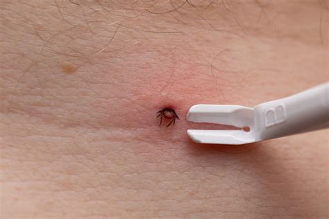 nástroje na odstránenie kliešťa