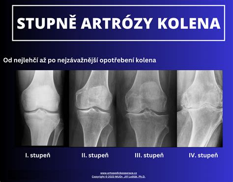 Röntgenová snímka kolena s rôznymi stupňami artrózy