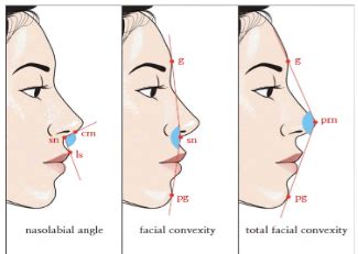 Príklad kefalometrickej analýzy profilu tváre