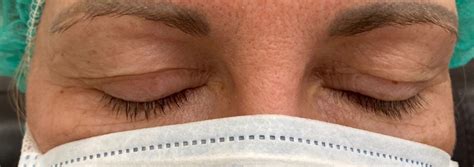 Fotografia tváre pacienta s obráteným zhryzom pred operáciou