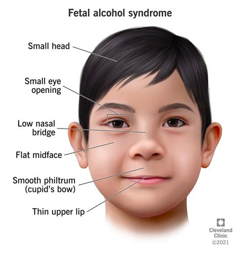fetal alcohol syndrome