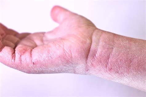 Druhy mastí na atopický ekzém