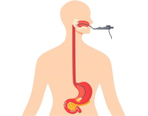 Ilustrácia gastroskopie