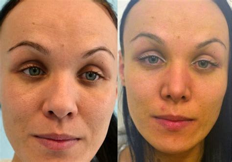 Štruktúra nosa pred a po rhinoplastike