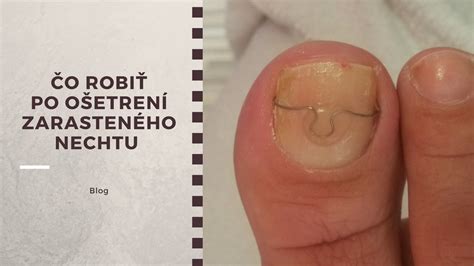 Ilustrácia štádií zarasteného nechtu