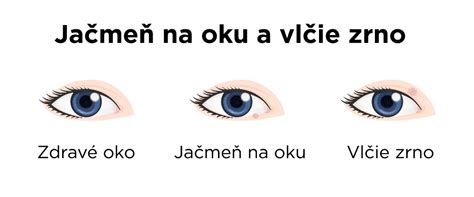 Infografika zobrazujúca rôzne príčiny červených očí