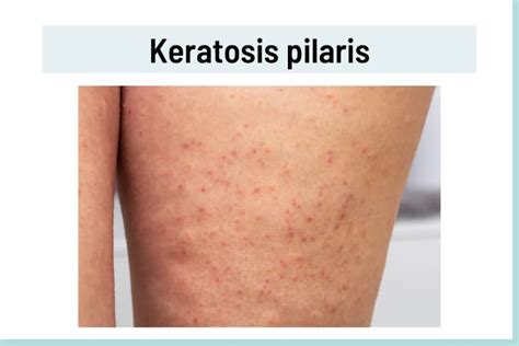 Ilustrácia Keratosis pilaris na koži