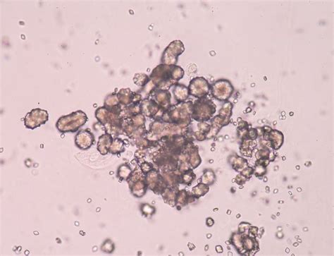 Kryštály kyseliny močovej v kĺbe pri dne