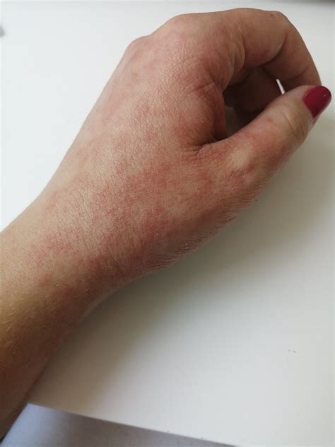 Fototerapia pri ekzéme