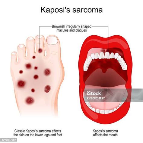 Schéma Kaposiho sarkómu