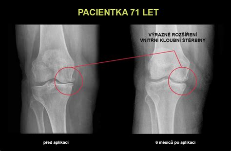 RTG snímok kolena s artrózou