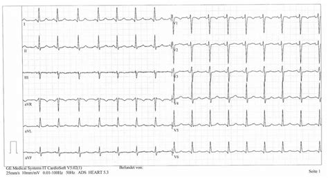 EKG záznam srdca