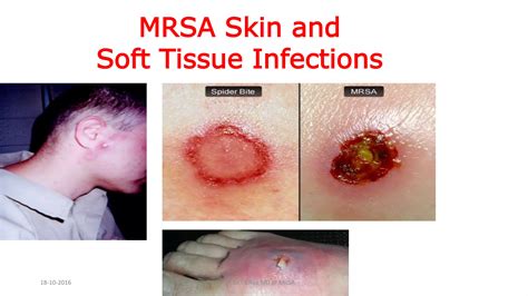 Symbol superrezistentnej baktérie MRSA