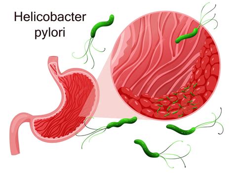 Obrázok baktérie Helicobacter pylori