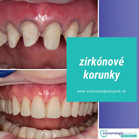 Ilustrácia diamantovej korunky