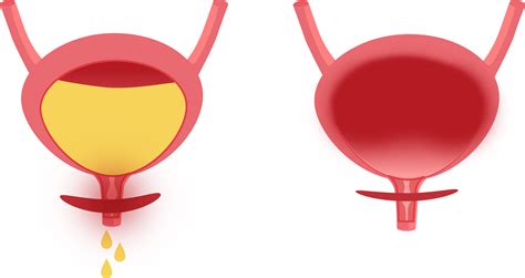 Schematický nákres ženskej panvy s vyznačeným močovým mechúrom a močovou trubicou