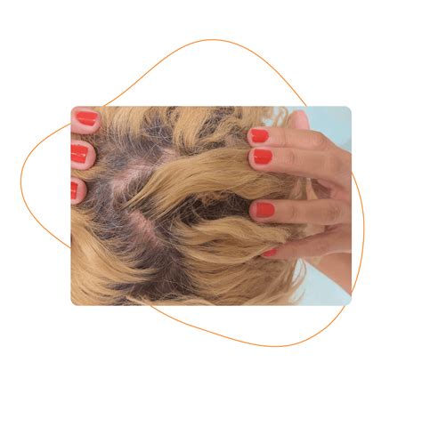 Obrázok znázorňujúci rozličné metódy liečby vypadávania vlasov