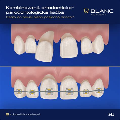 Ilustrácia kombinovanej liečby bipolárnej poruchy
