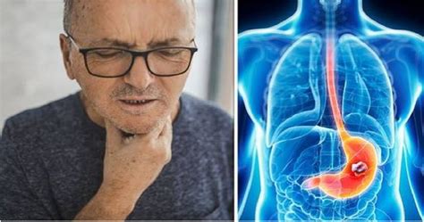 Graf príznakov podráždeného žalúdka