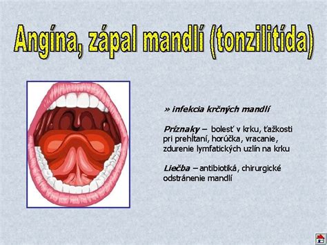 Ilustrácia krčných mandlí v hrdle