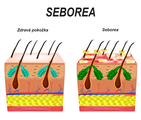 Porovnanie zdravej sadbovej hľuzy a konzumného zemiaku s klíčkami