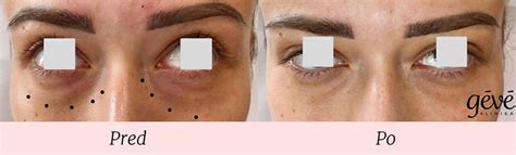 Aplikácia oleja na tvár