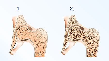 Ilustrácia kostí a osteoporózy