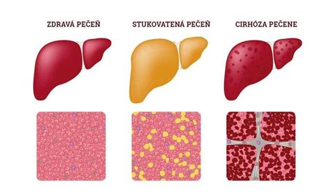 Ilustračné foto vyprážanej pečene