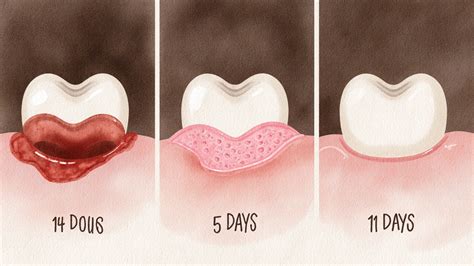 Grafické znázornenie hojenia rany po extrakcii zuba
