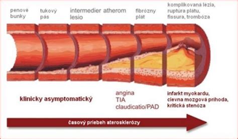 Ilustrácia procesu aterosklerózy v cievach