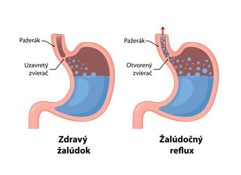 Nákres endoskopického vyšetrenia pažeráka