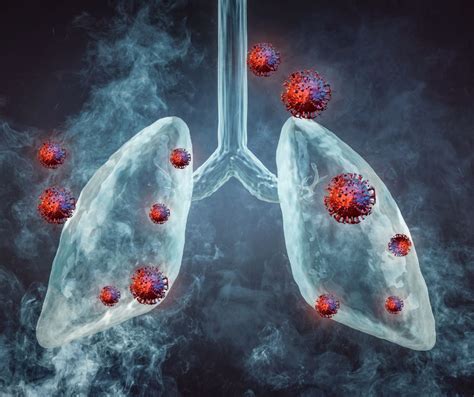 Ilustrácia príznakov bronchitídy