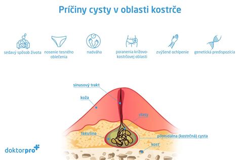 Štruktúra echinokokovej cysty