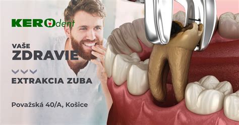 Ilustrácia chirurgickej extrakcie zuba