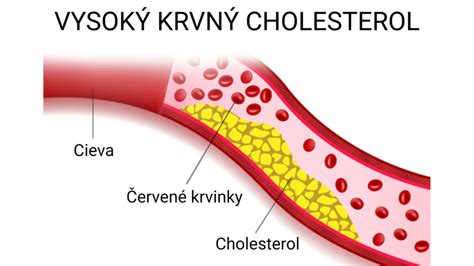 graf srdca a ciev s nápisom cholesterol