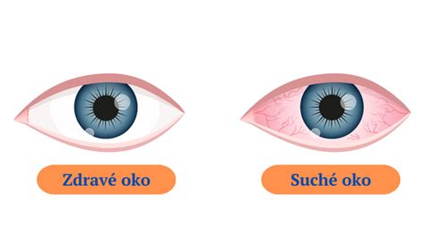 obklad na zapálené oko